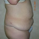 Belt Lipectomy Before & After Patient #2012