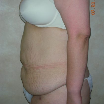 Belt Lipectomy Before & After Patient #2012