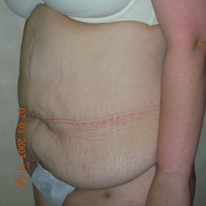 Belt Lipectomy Before & After Patient #2012