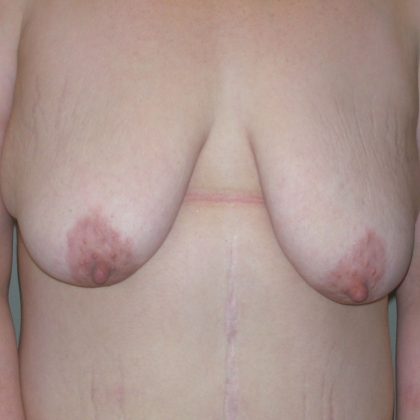 Breast Augmentation Before & After Patient #2013