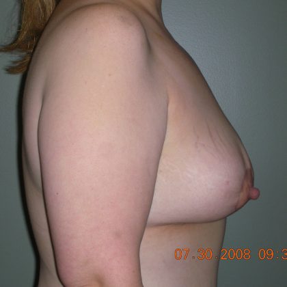 Breast Lift Before & After Patient #2014