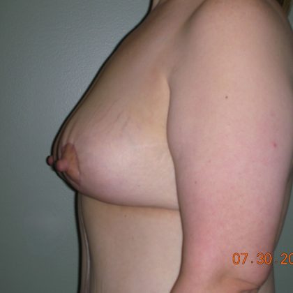 Breast Lift Before & After Patient #2014