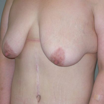 Breast Lift Before & After Patient #2014