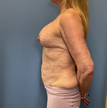 Breast Lift Before & After Patient #2015