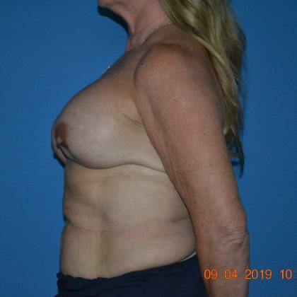 Breast Lift Before & After Patient #2015