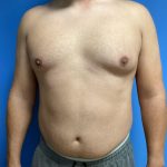 Gynecomastia Before & After Patient #2016