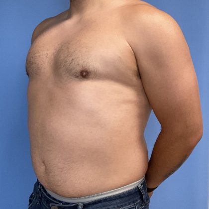 Gynecomastia Before & After Patient #2016