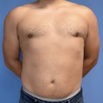 Gynecomastia Before & After Patient #2016