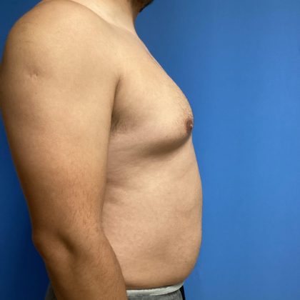 Gynecomastia Before & After Patient #2016