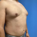 Gynecomastia Before & After Patient #2016