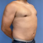 Gynecomastia Before & After Patient #2016