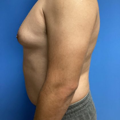 Gynecomastia Before & After Patient #2016