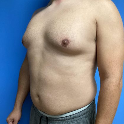 Gynecomastia Before & After Patient #2016