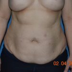 Tummy Tuck Before & After Patient #2017