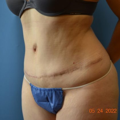 Tummy Tuck Before & After Patient #2017