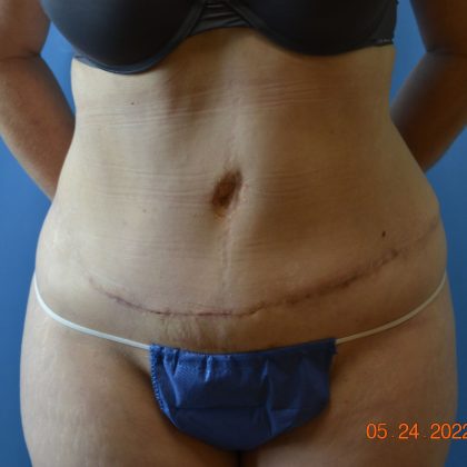 Tummy Tuck Before & After Patient #2017