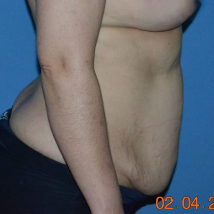 Tummy Tuck Before & After Patient #2017