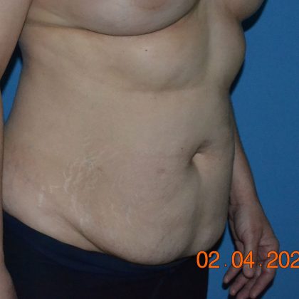 Tummy Tuck Before & After Patient #2017