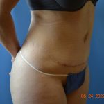 Tummy Tuck Before & After Patient #2017