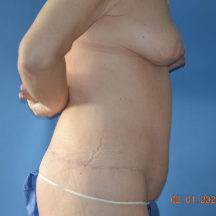 Belt Lipectomy Before & After Patient #1801