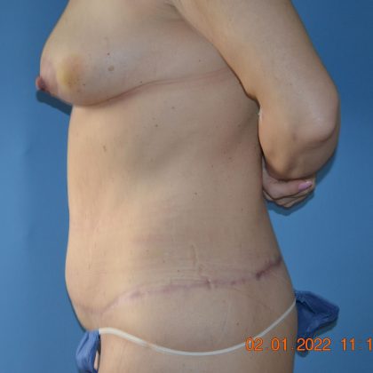 Belt Lipectomy Before & After Patient #1801