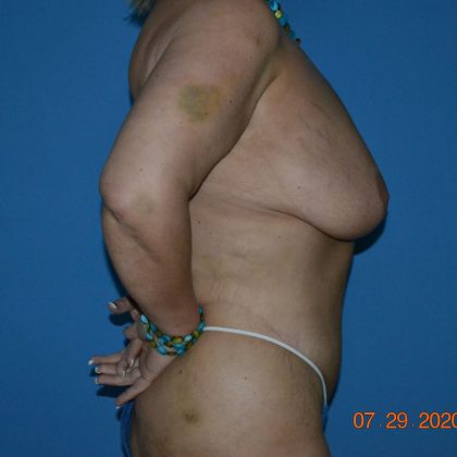 Belt Lipectomy Before & After Patient #1802