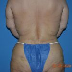 Belt Lipectomy Before & After Patient #1802