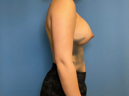 Breast Augmentation Before & After Patient #1804