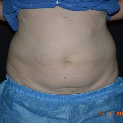 CoolSculpting Before & After Patient #1805