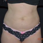 CoolSculpting Before & After Patient #1805