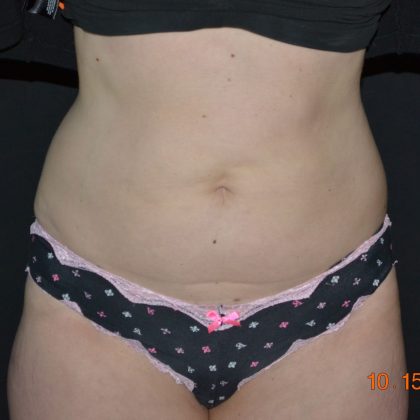 CoolSculpting Before & After Patient #1805