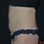 CoolSculpting Before & After Patient #1805