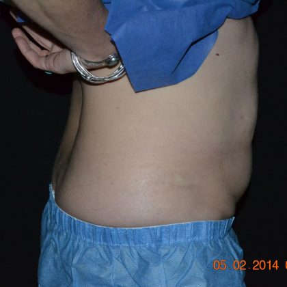 CoolSculpting Before & After Patient #1805