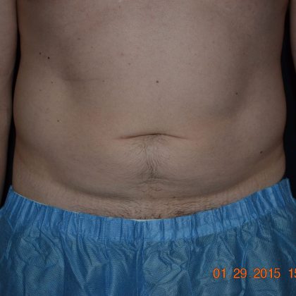 CoolSculpting Before & After Patient #1806