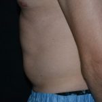 CoolSculpting Before & After Patient #1806