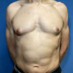 Gynecomastia Before & After Patient #1808