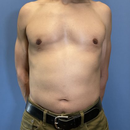 Gynecomastia Before & After Patient #1808