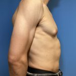 Gynecomastia Before & After Patient #1808