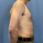 Gynecomastia Before & After Patient #1808