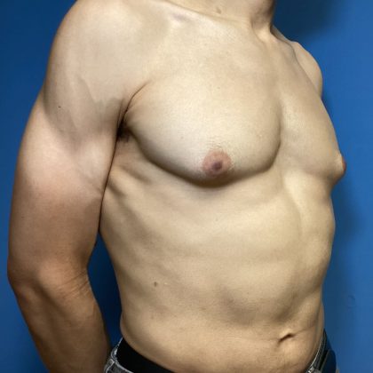 Gynecomastia Before & After Patient #1808