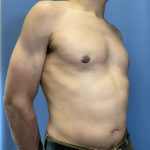 Gynecomastia Before & After Patient #1808