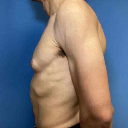 Gynecomastia Before & After Patient #1808