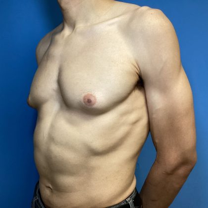 Gynecomastia Before & After Patient #1808